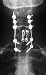 Anterior and posterior cervical spine fusion AP view